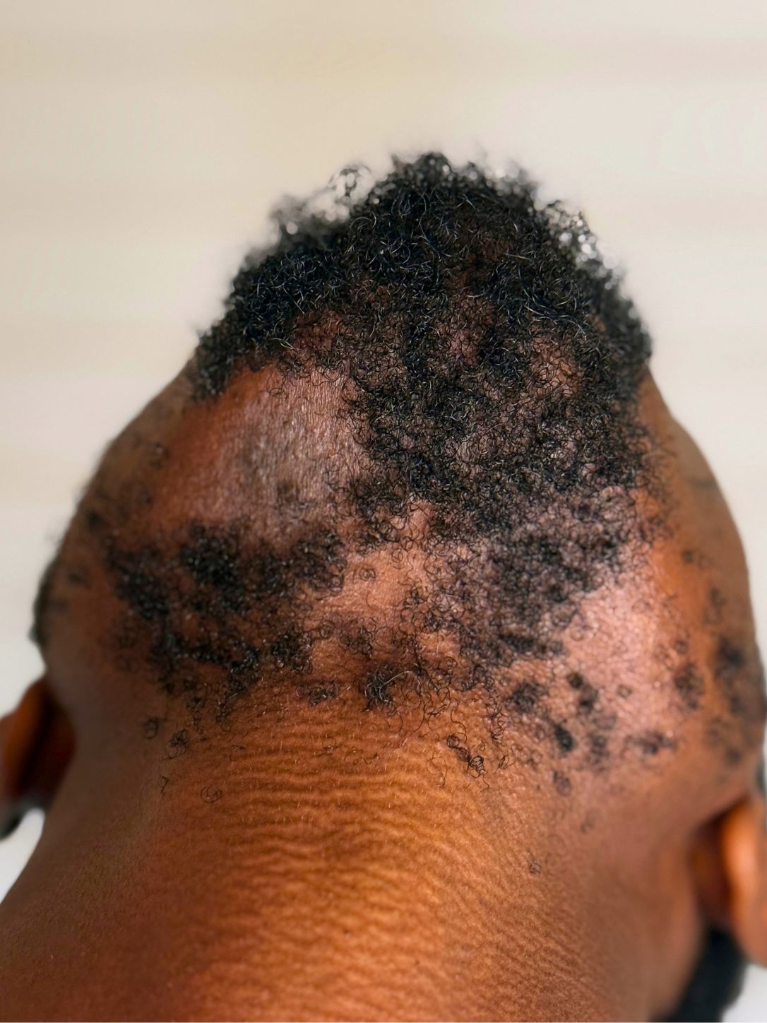 AULYV Tempered Sugar Thick Coarse Beard Hair Removal Results