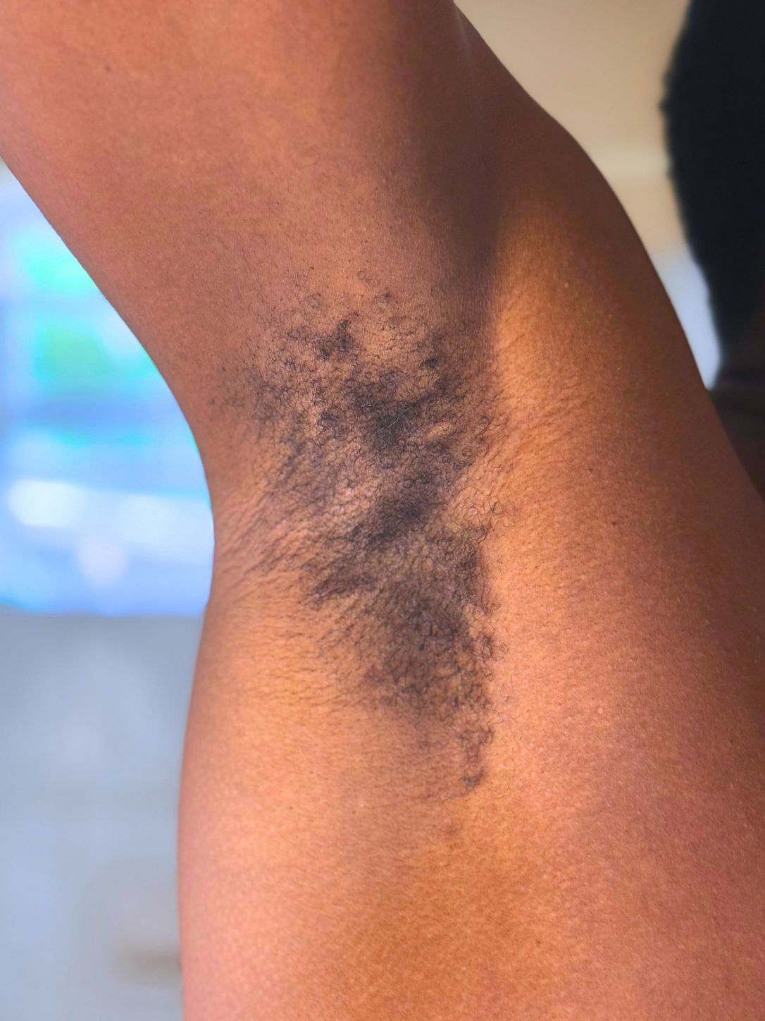 Before and After Hair Removal Results Using Tempered Sugar By AULYV-2