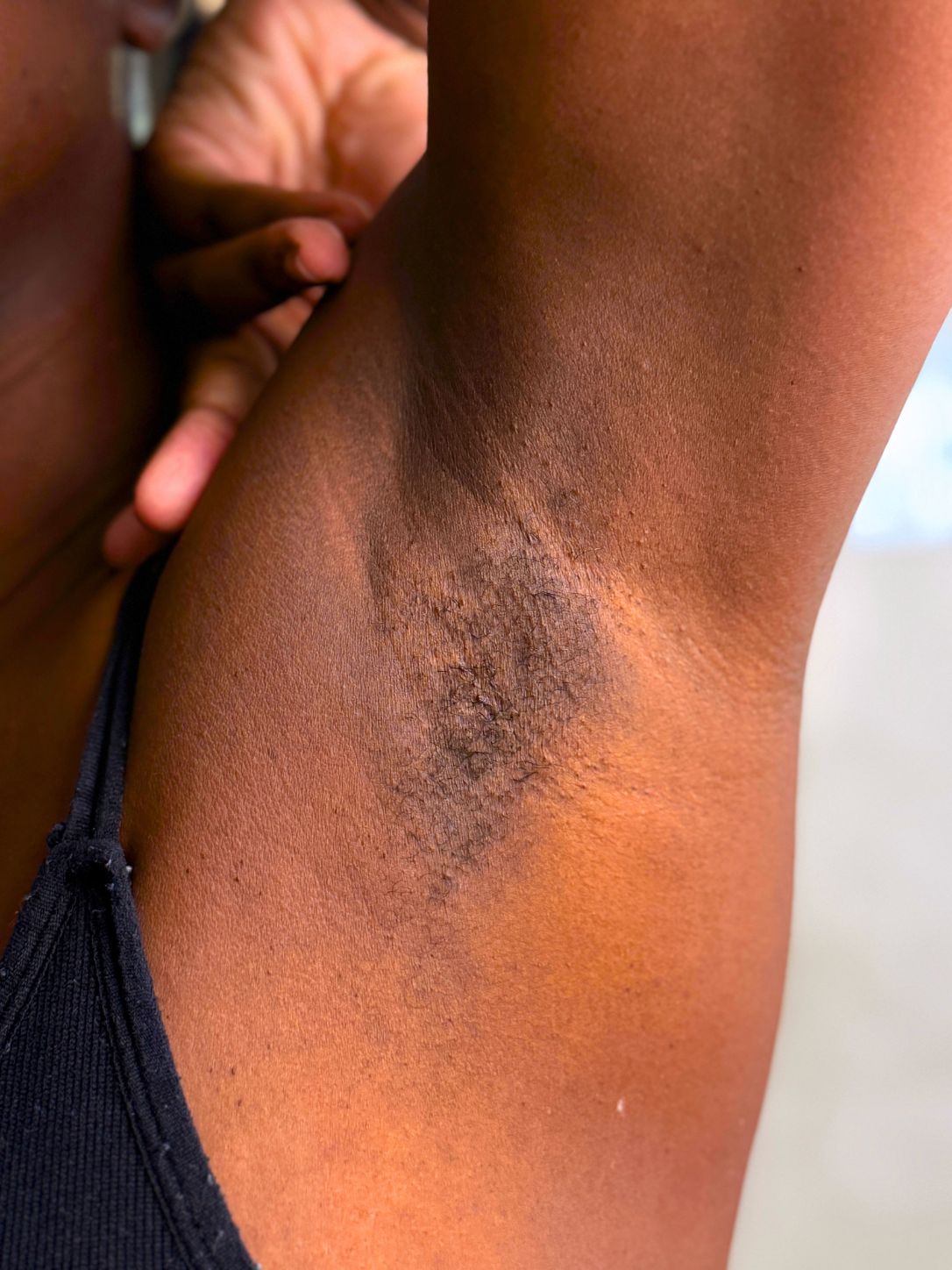 Before and After Hair Removal Results Using Tempered Sugar By AULYV-3