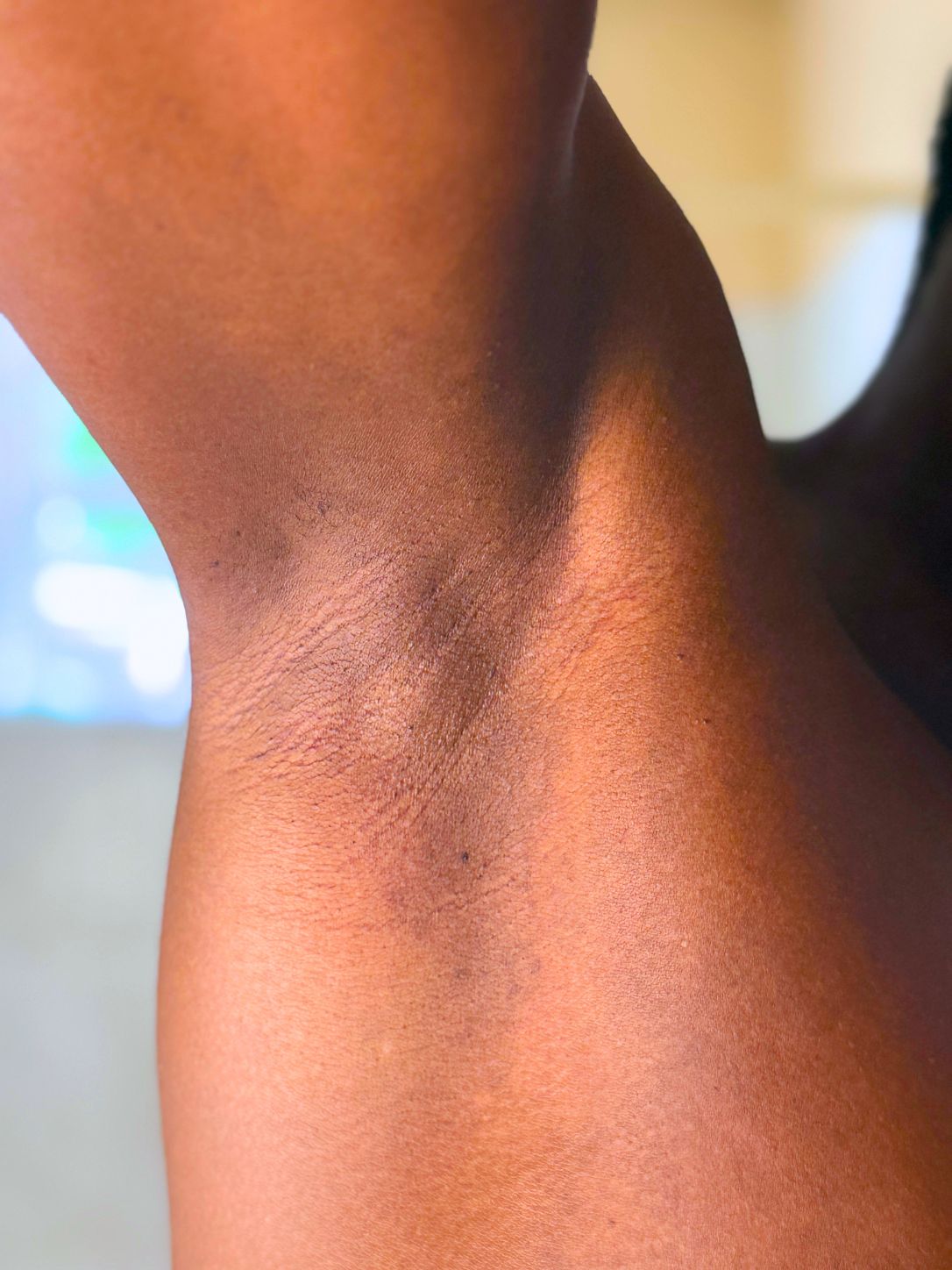 Before and After Hair Removal Results Using Tempered Sugar By AULYV
